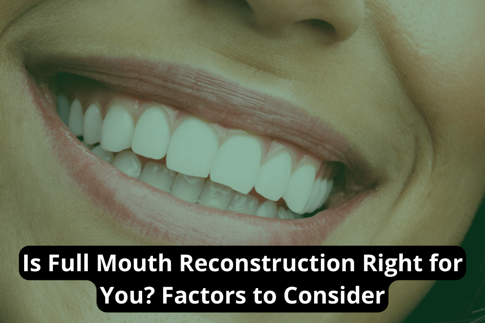 Is Full Mouth Reconstruction Right for You? Factors to Consider