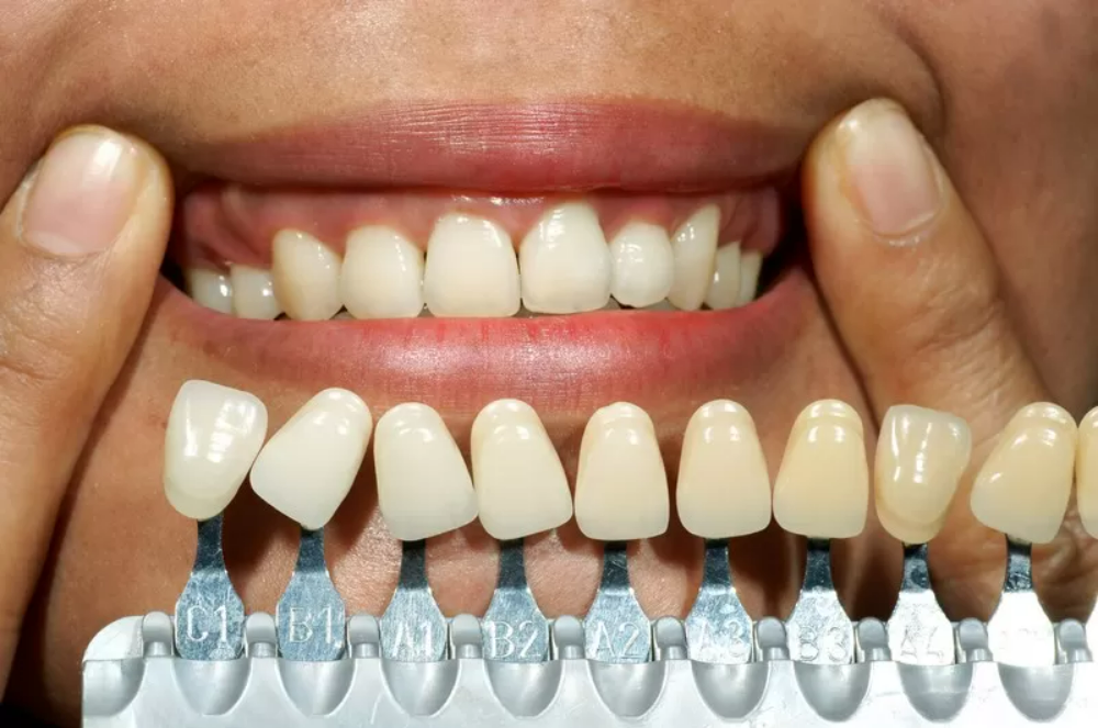 Changing of Tooth Color