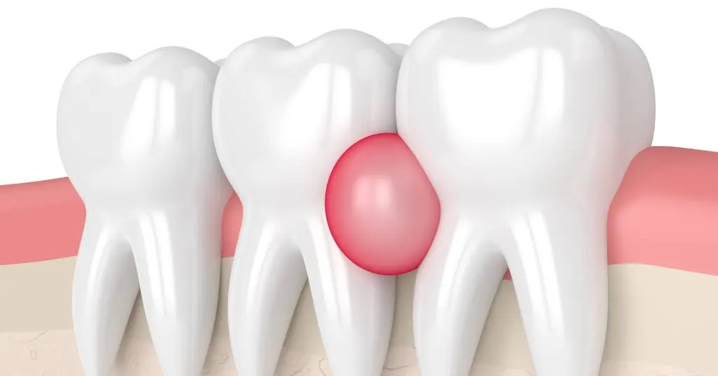Dental Abscess: Identifying When It Becomes an Emergency — Mallard Creek Dental, Taylor TX