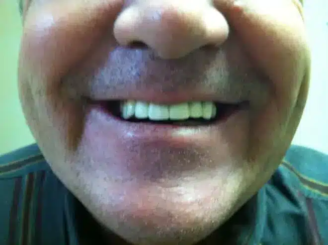 Dental bridge after, at Mallard Creek Dental in Taylor, TX