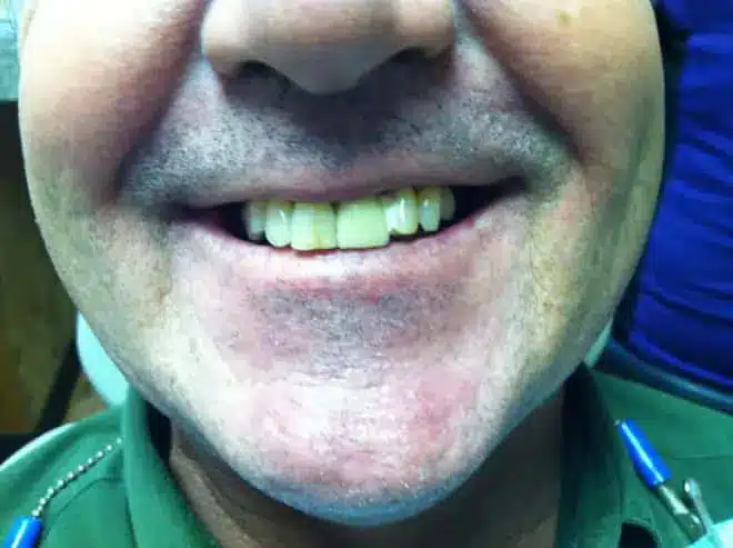 Dental bridge before, at Mallard Creek Dental in Taylor, TX