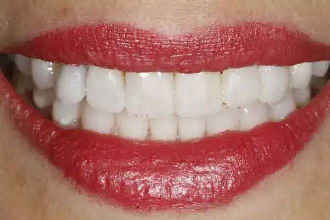 Composite chairside veneers after, at Mallard Creek Dental in Taylor, TX