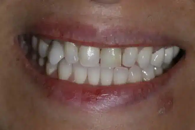 Composite chairside veneers before, at Mallard Creek Dental in Taylor, TX