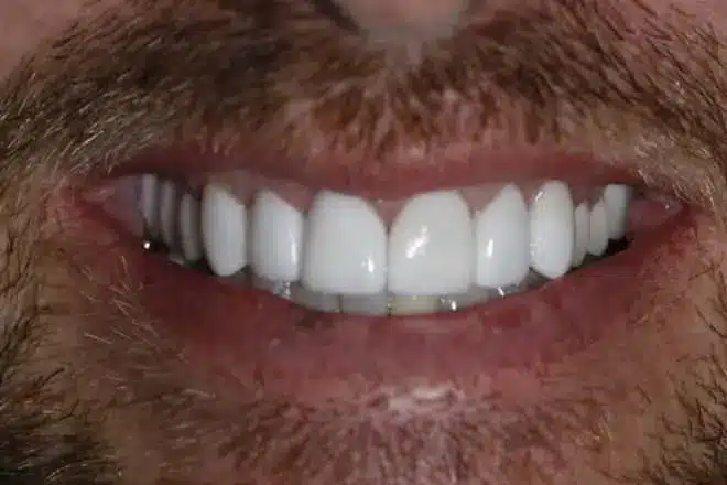 Crowns and veneers after, at Mallard Creek Dental in Taylor, TX
