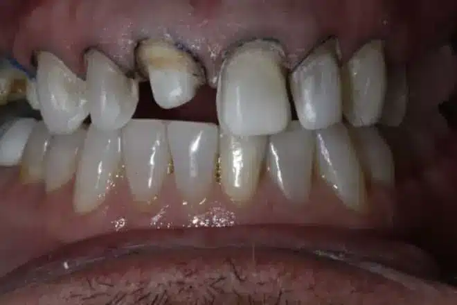 Crowns and veneers before, at Mallard Creek Dental in Taylor, TX
