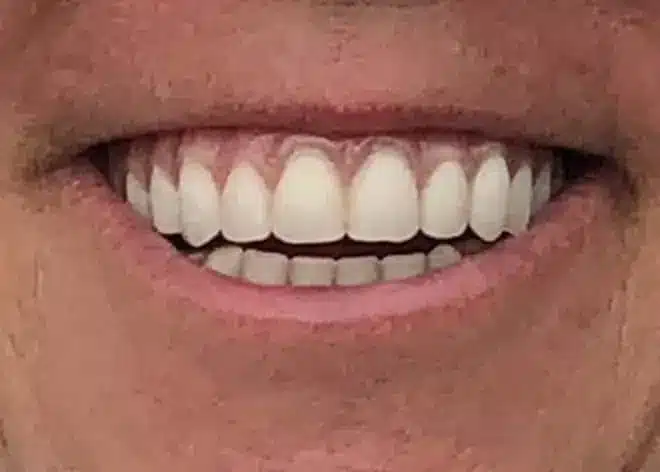 Dental transformation after, at Mallard Creek Dental in Taylor, TX