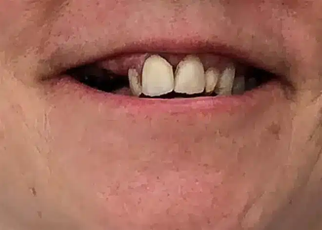 Dental transformation before, at Mallard Creek Dental in Taylor, TX