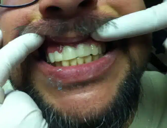 Extraction and temporary bridge after, at Mallard Creek Dental in Taylor, TX