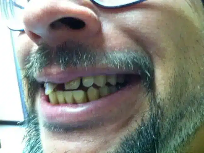 Extraction and temporary bridge before, at Mallard Creek Dental in Taylor, TX