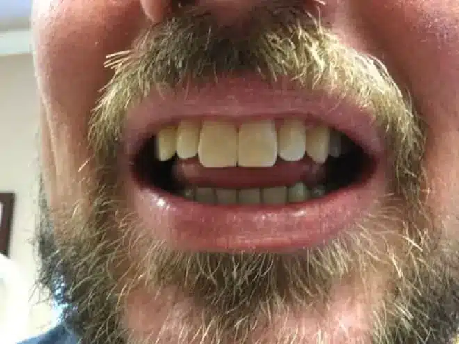 Porcelain veneers after, at Mallard Creek Dental in Taylor, TX