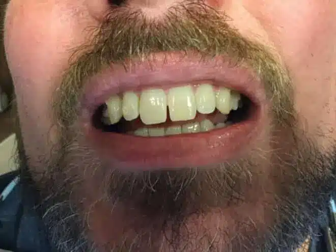 Porcelain veneers before, at Mallard Creek Dental in Taylor, TX