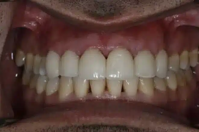 Porcelain veneers after, at Mallard Creek Dental in Taylor, TX
