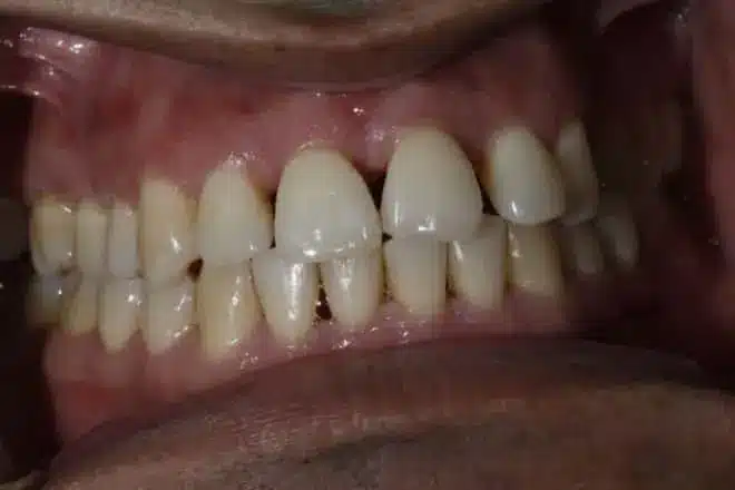 Porcelain veneers before, at Mallard Creek Dental in Taylor, TX