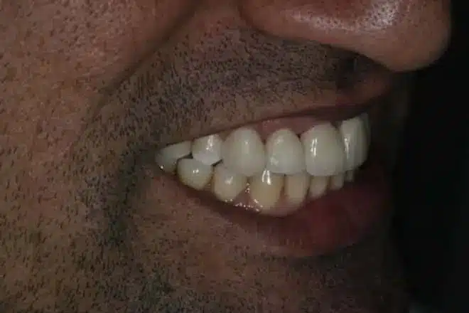 Porcelain veneers after, side view, at Mallard Creek Dental in Taylor, TX