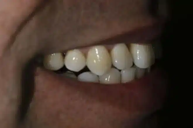 Porcelain veneers before, side view, at Mallard Creek Dental in Taylor, TX
