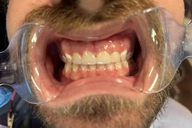 Upper arch restoration after, at Mallard Creek Dental in Taylor, TX