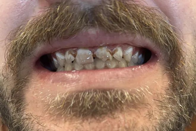 Upper arch restoration before, at Mallard Creek Dental in Taylor, TX