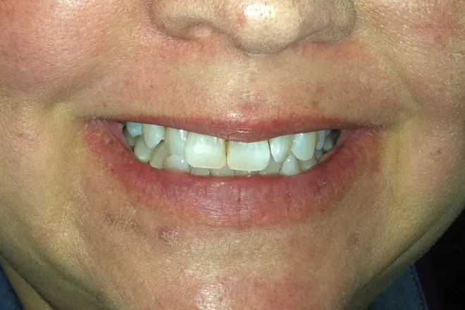 Upper bleaching after, at Mallard Creek Dental in Taylor, TX