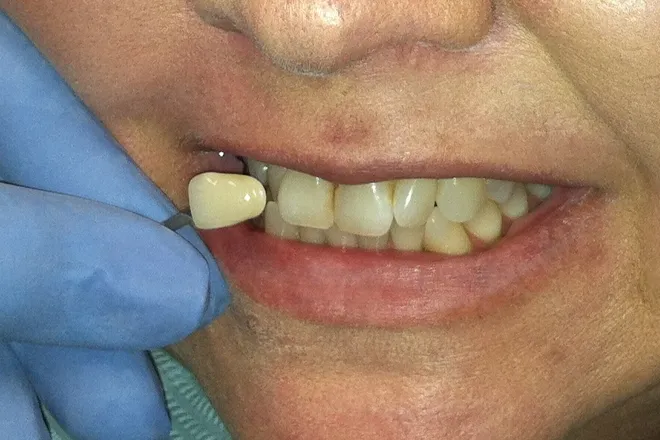 Upper bleaching before, at Mallard Creek Dental in Taylor, TX