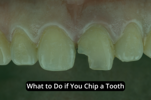 Close-up of upper front teeth with one visibly chipped; text overlay reads, "Chipped Tooth? Here's What to Do if You Chip a Tooth.